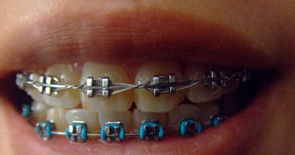Shingalingaling Braces Diary