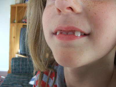 Braces Fangs