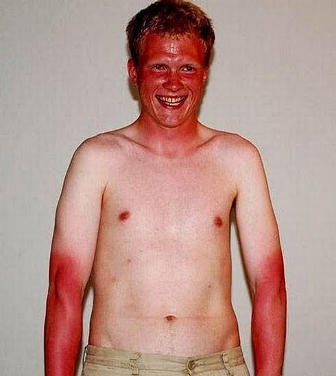 Bad Sunburn Pictures