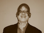 E. Jerome Malry- A Classical Pianist who lives with Vitiligo