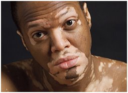 Lee Thomas -Entertainment Reporter living with  Vitiligo