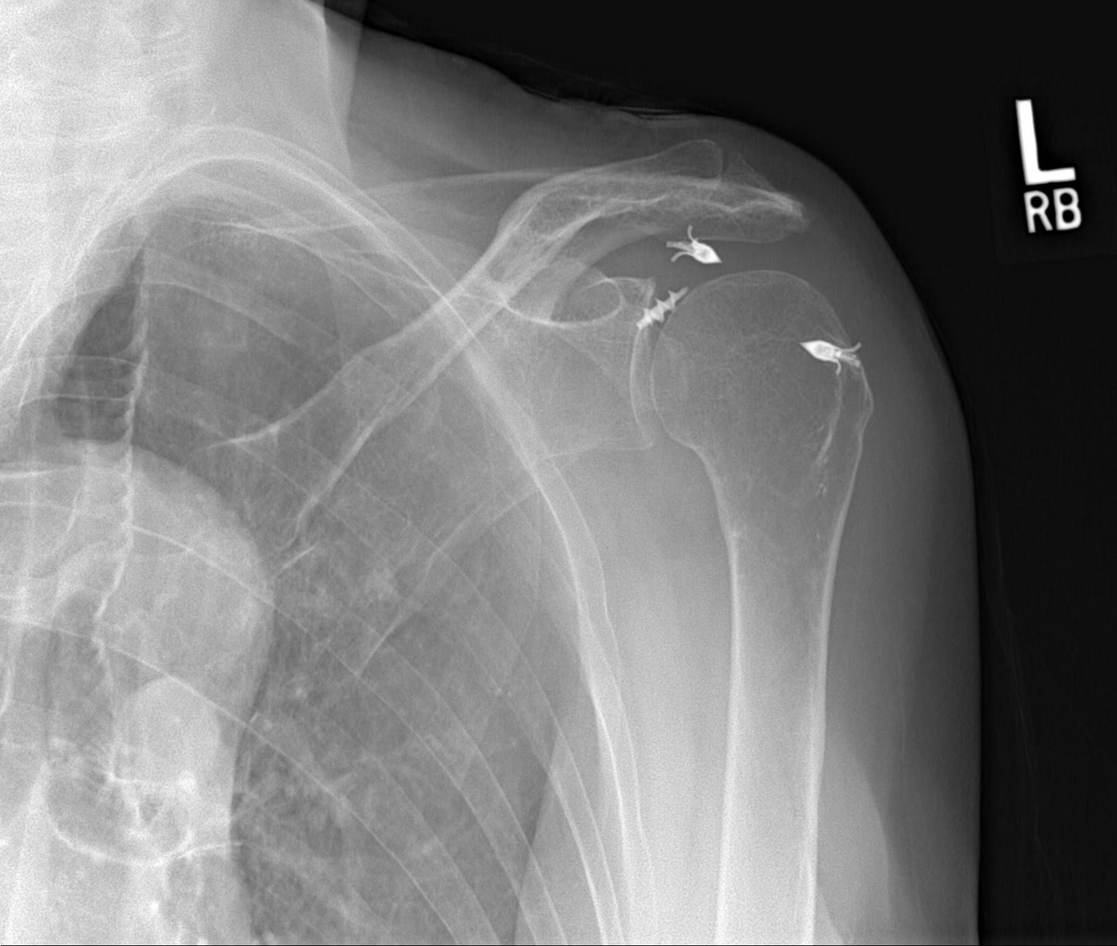 Interesting Shoulder Xrays James Mazzara MD Shoulder Knee Elbow