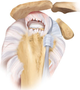 of a rotator cuff tear