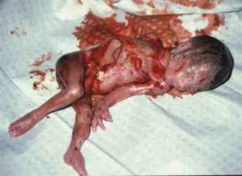 http://3.bp.blogspot.com/_7yvM8ChXTKg/SVFOn-PUfKI/AAAAAAAAAKA/okuSGDFy_yQ/s400/tipos-de-aborto6.jpg