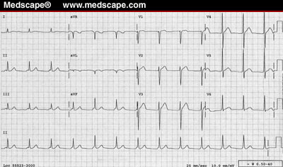 EKG Mean Axis and Supraventricular Rhythm.