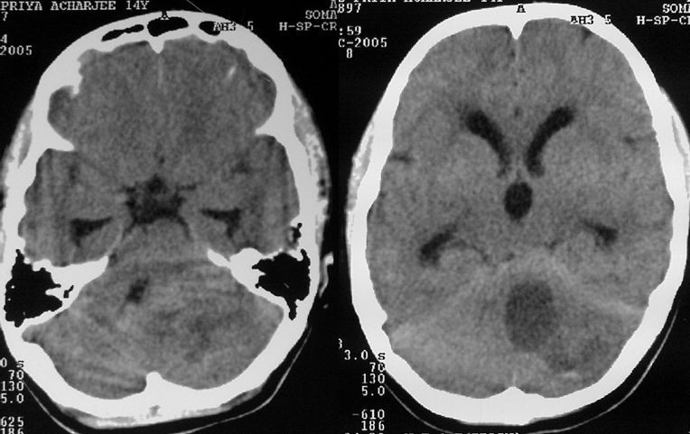 The 5-year survival rate is between 95-100or complete resection alone.  Cerebellar tumors are generally low-grade pilocytic, thus making complete  resection.