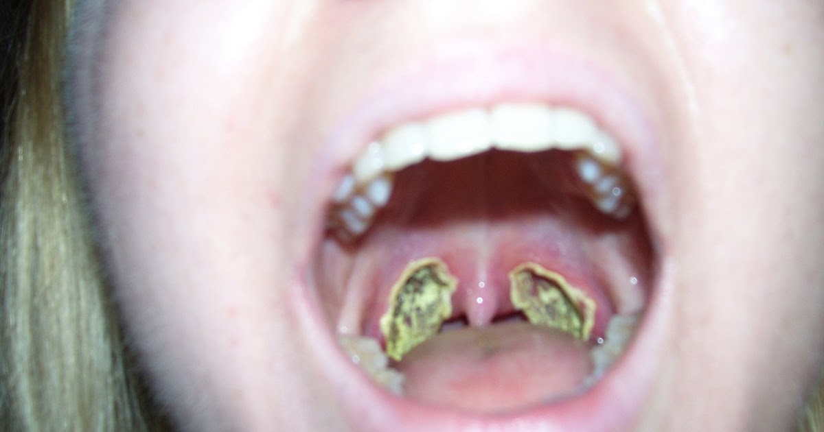 Chronicles of an Adult Tonsillectomy Wednesday July 8, 2009 Day of