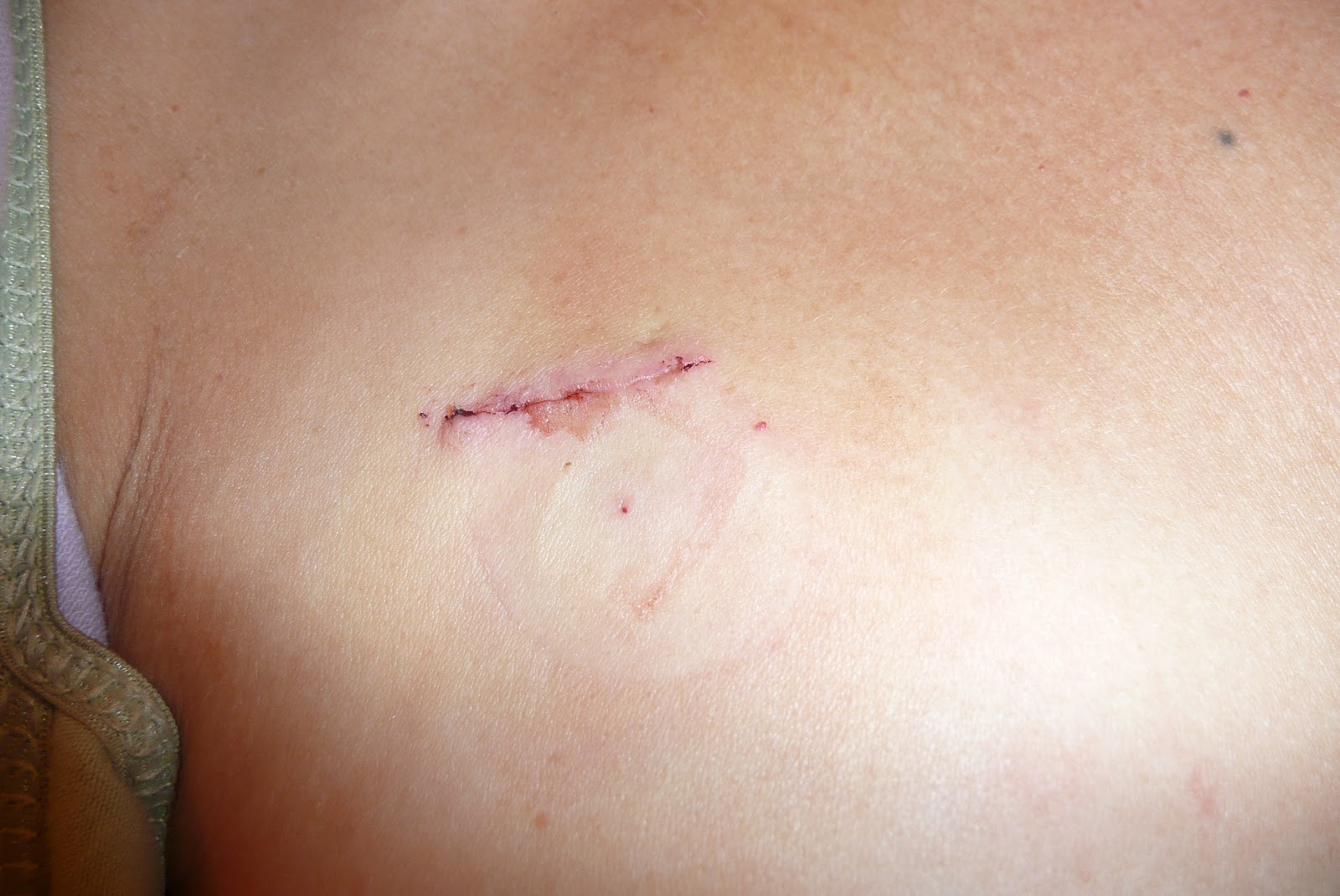 New Scar