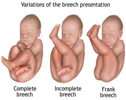 Complete Breech