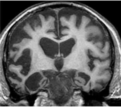atrophy brain