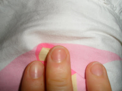 Ridges On Fingernails Deficiency. of Sherilyn's fingernail.