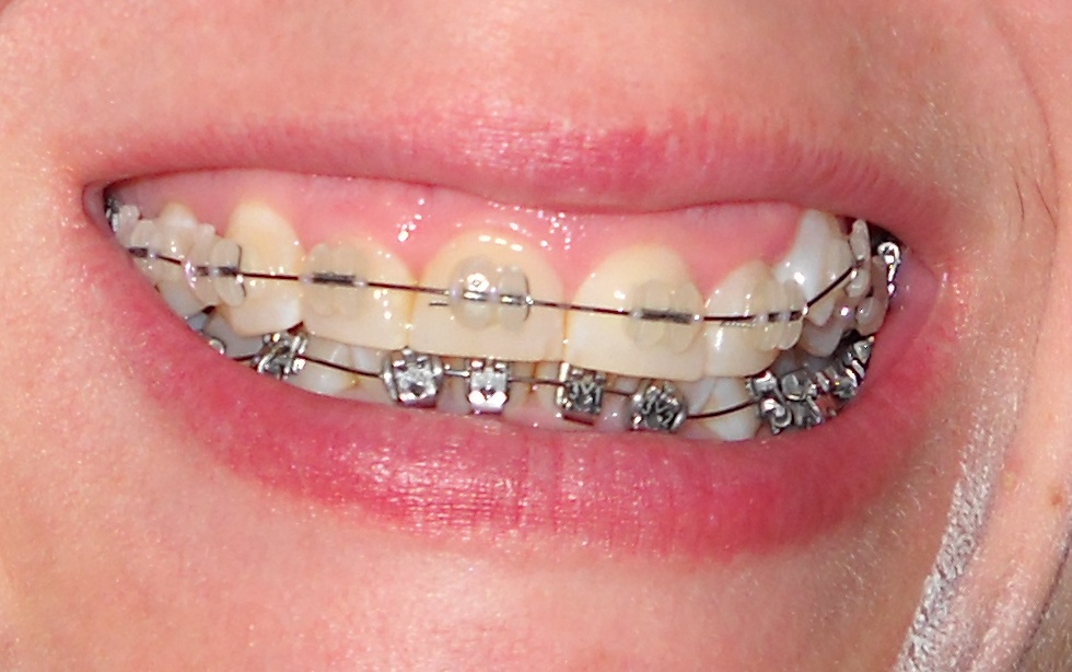 Brace Face II The Return of Squeaker Beak Week One Progress Report