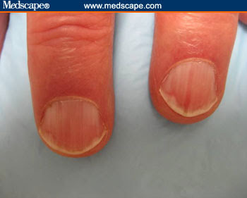 With pink or red nail discoloration,