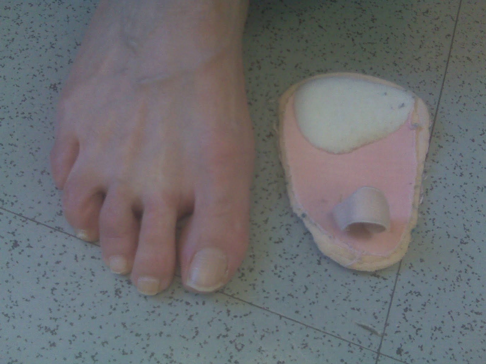 Hammer Toe