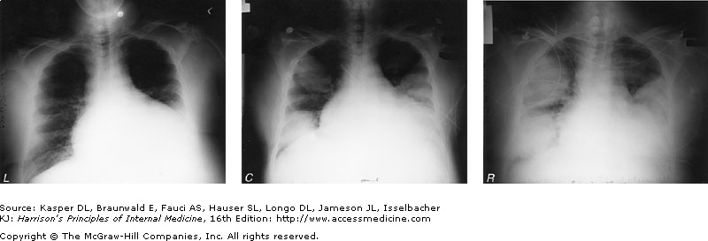 Chest radiographic findings in a 52-year-old man who presented with pneumonia subsequently diagnosed as Legionnaires' disease. The patient was a cigarette smoker with chronic obstructive pulmonary disease and alcoholic cardiomyopathy; he had received glucocorticoids. L. pneumophila was identified by DFA staining and culture of sputum. Left: Baseline chest radiograph showing long-standing cardiomegaly. Center: Admission chest radiograph showing new rounded opacities. Right: Chest radiograph taken 3 days after admission, during treatment with erythromycin.
