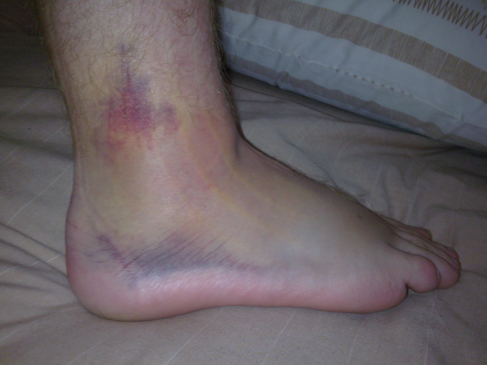 Twisted Ankle Swelling
