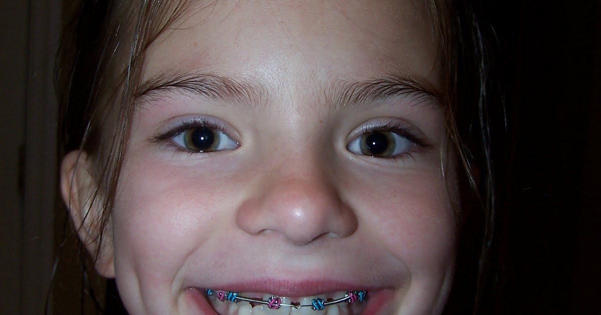 The Cincinnati Browns Two Faces With Braces