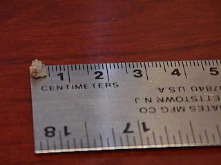 scripted notions kidney stones again size of kidney stones