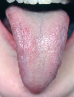 Deviated Tongue