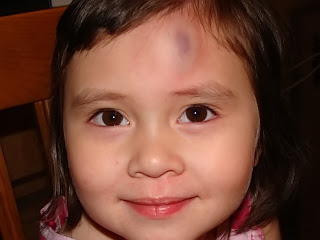 big bruise