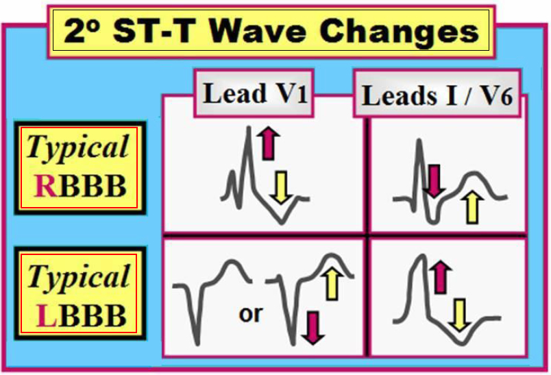 rbbb ecg