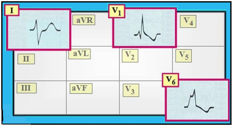 Basic Ekg Interpretation