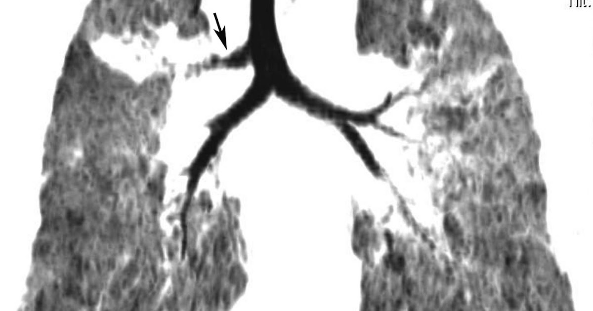 Radiodiagnosis Imaging is AmazingInteresting cases Tracheal bronchus