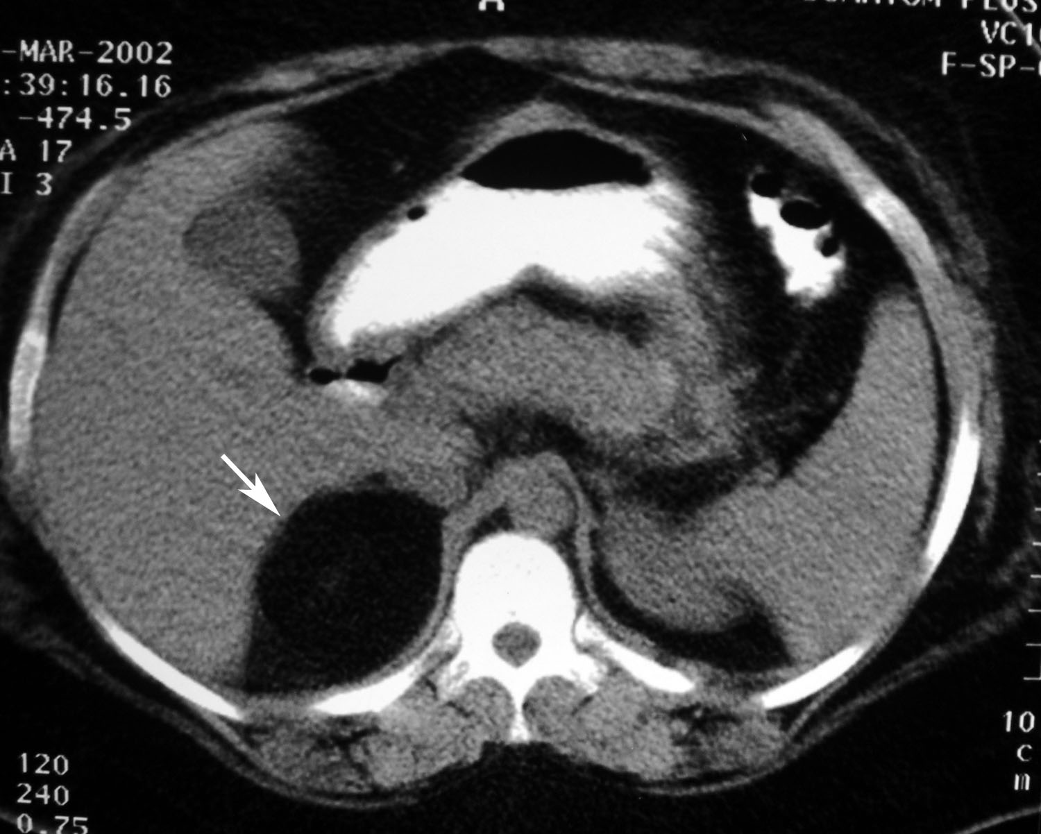 Ct Adrenal
