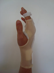 ex. static splint ©