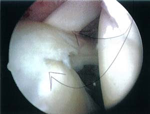 Slap Tear Rehab Time