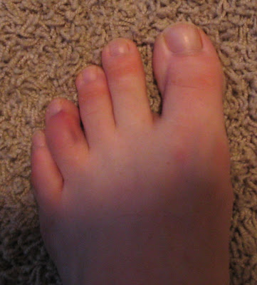 Broken Toe