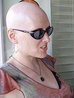http://3.bp.blogspot.com/_AomIg2-Ao9g/TPEeMuXBzQI/AAAAAAAAAo4/7dIodSrnRIk/s1600/150px-AlopeciaTotalis.jpg