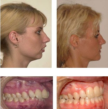 braces before change surgical dental orthodontic correct face surgery orthodontics severe procedure success