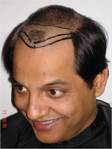 NABEEL (T.V ACTOR BEFORE SURGERY )