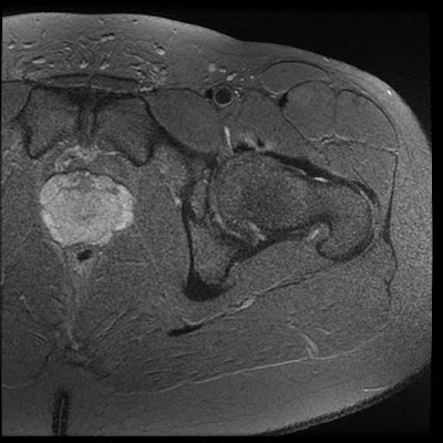 2015 08 01 Archive >> Radiology Cases: Snapping Hip Syndrome 2015 08 01 Archive >> Radiology Cases: Snapping Hip Syndrome