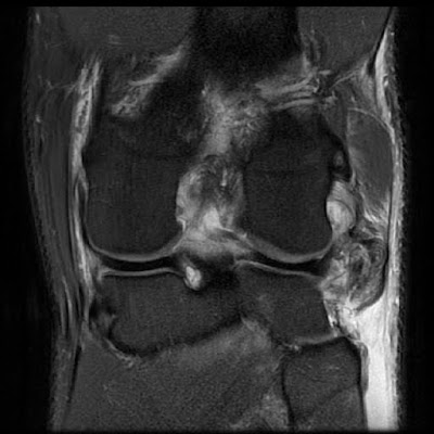 Torn Lcl Mri