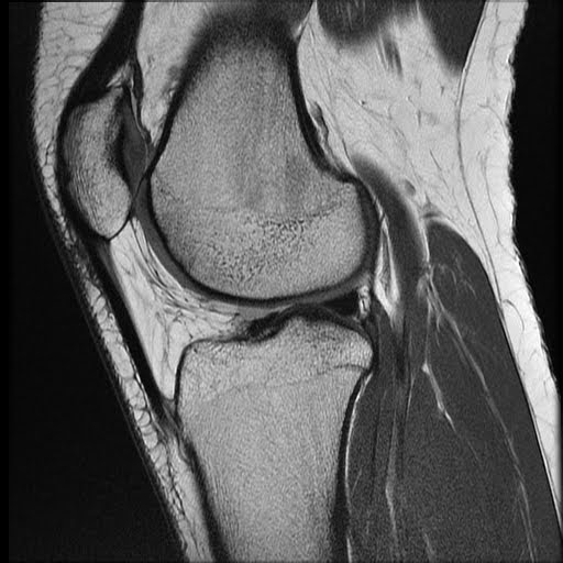 Radiology Cases Lateral Patella Subluxation, Patella Tilt, Shallow