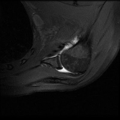 Aber Mri