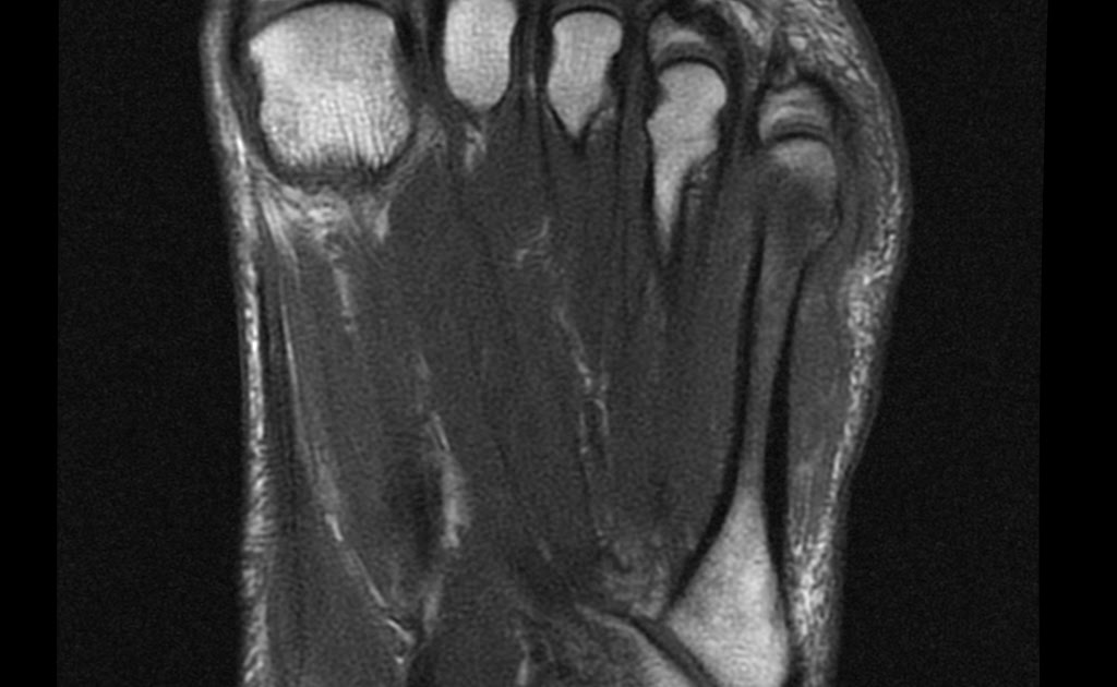 Radiology Cases AS with lateral foot pain ? AS erosion or gout