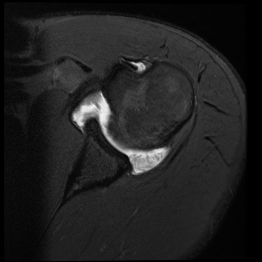 Radiology Cases Rice Bodies in RA