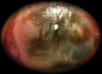 Amniotic Sack