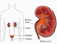 A VIEW OF A KIDNEY STONE