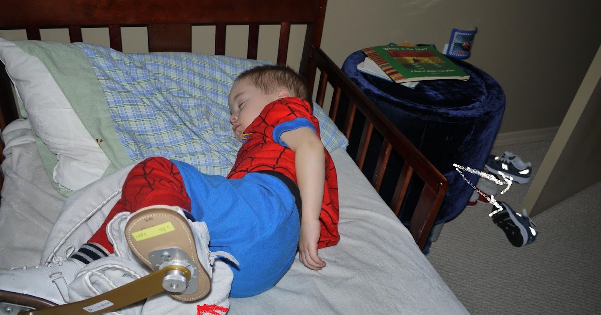 The journey of motherhood Clubfoot Treatment