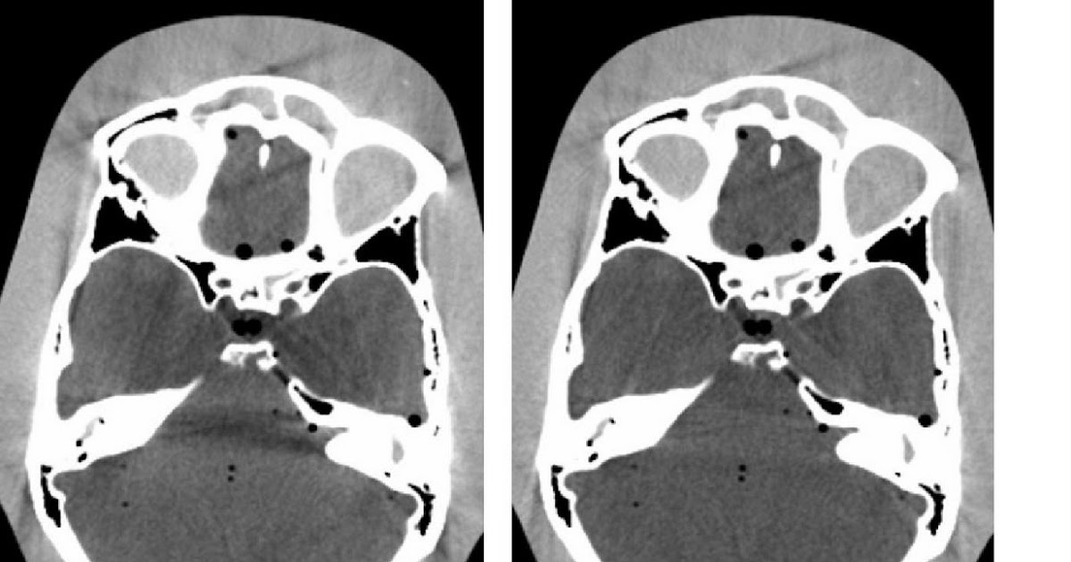 CT_physics_2009 Banding Artifacts