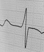 ekg strip