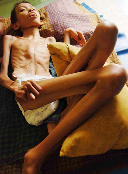 Foto orang kekurangan gizi 23 Foto orang kekurangan gizi 61