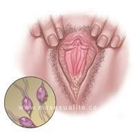 La tricomoniasis es una