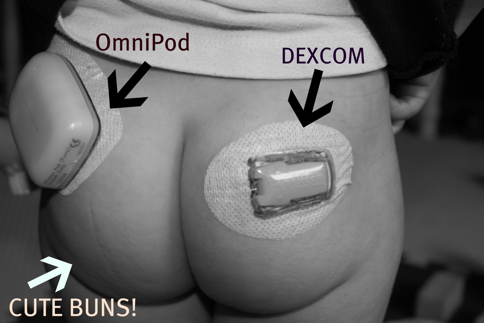 Dexcom Sensor