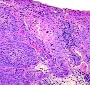Carcinoma Of Esophagus