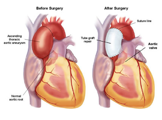 Aortic Aneurysm Surgery